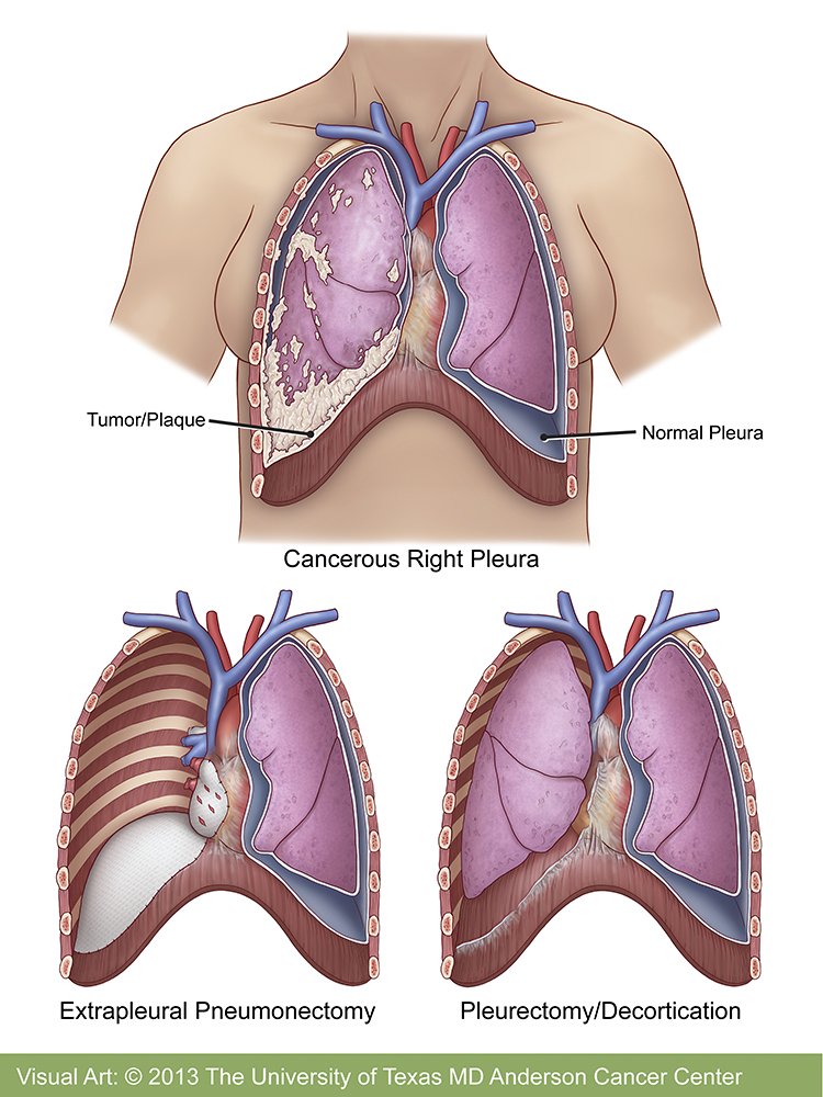 cancer new treatment for mesothelioma